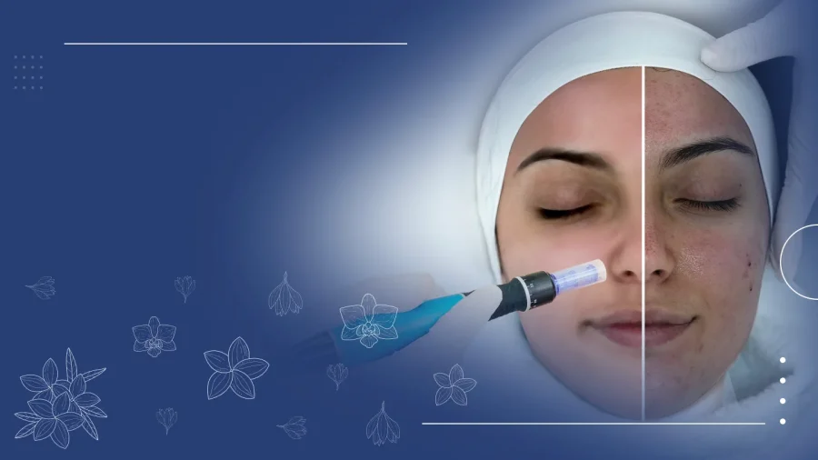 Dermapen Microneedling in Ras Al Khaimah: Your Complete Guide to Radiant, Rejuvenated Skin